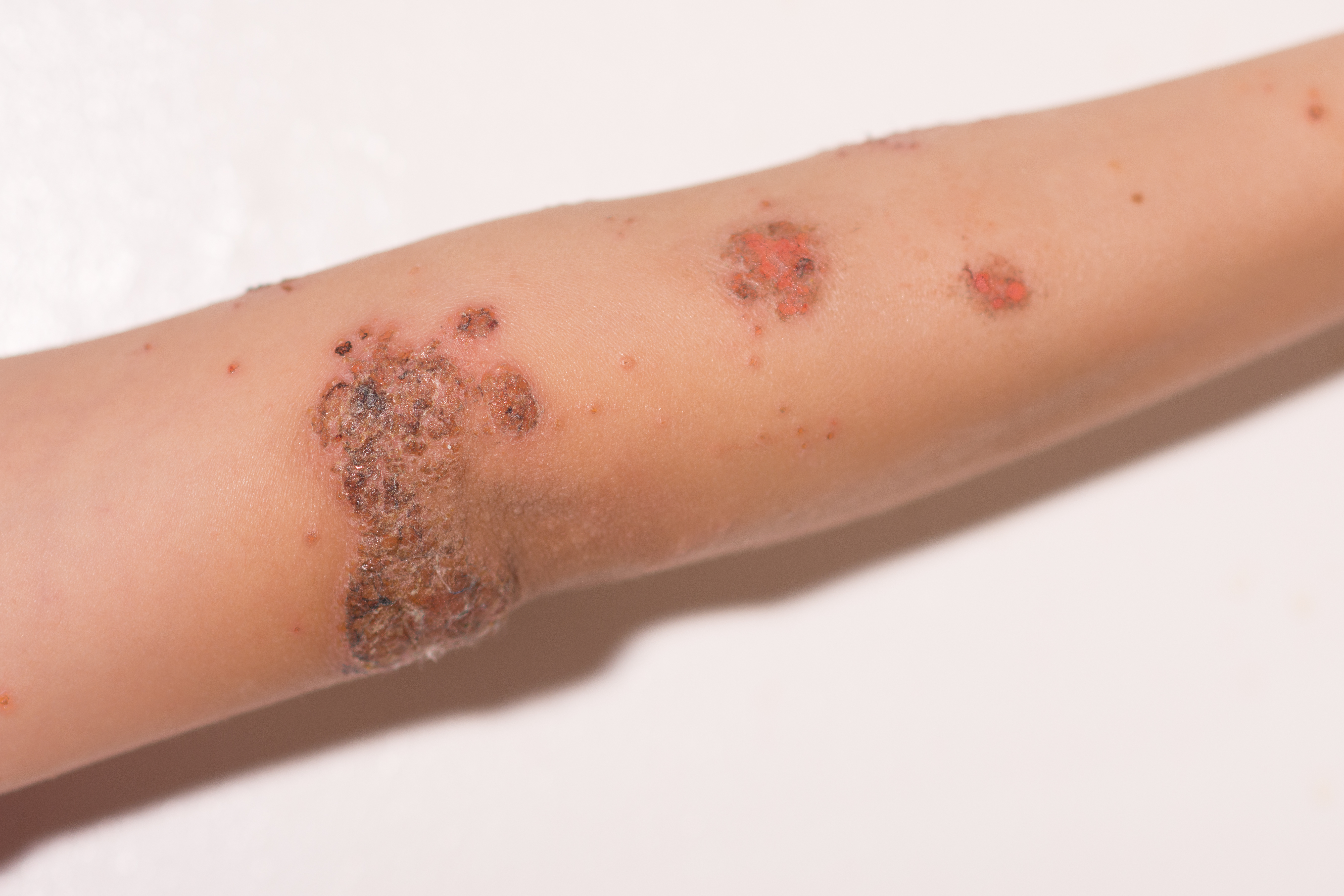 Child's,Arm,With,Impetigo,Skin,Condition