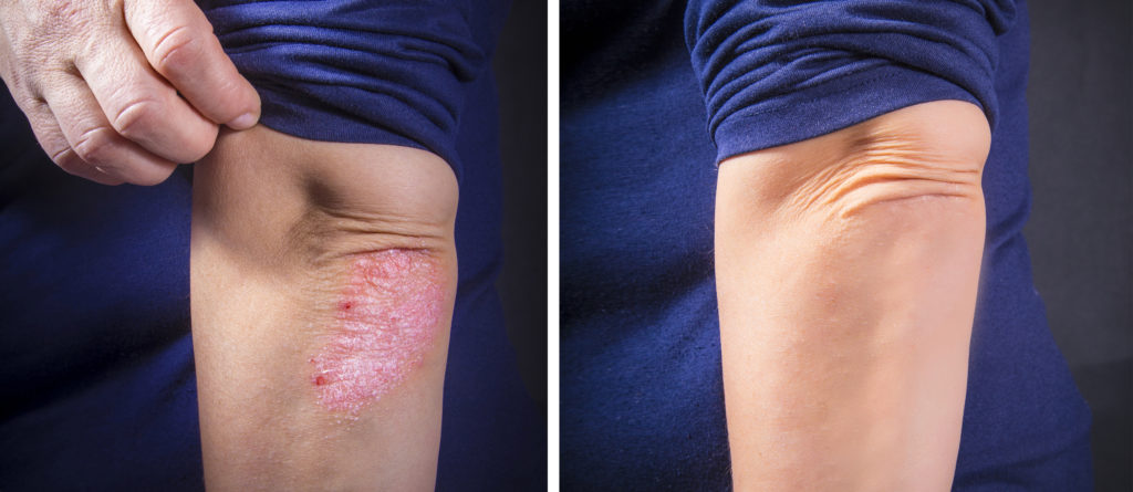 Psoriasis,On,Lady's,Elbow,Before,And,After,Treatment.,Close,Up