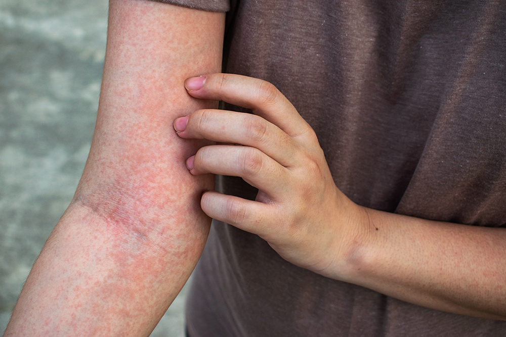 Post Infection Skin Rash Infections & Rashes - Scottsdale Skin Boutique & Dermatology