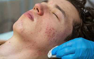 Understanding the Different Types of Acne and How to Treat Them