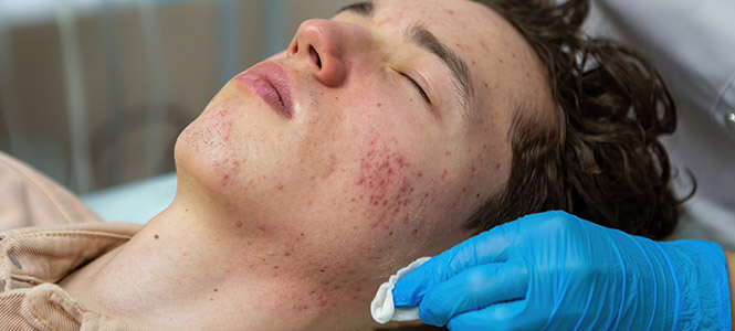 someone receiving acne treatment for different types of acne