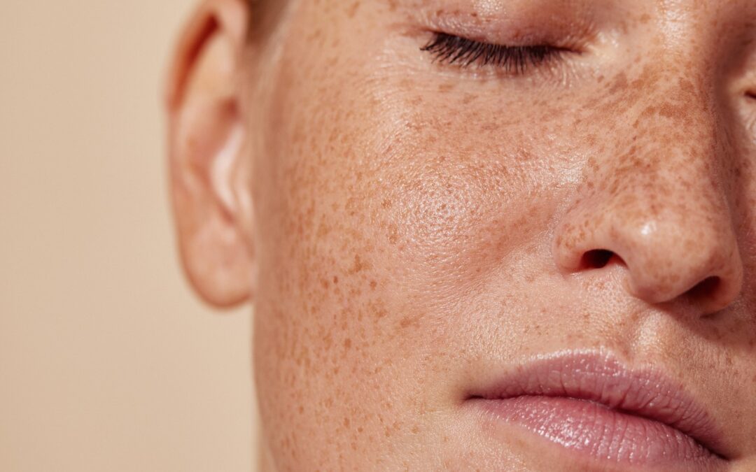 IPL Therapy: Say Goodbye to Sun Damage and Hello to Radiant Skin