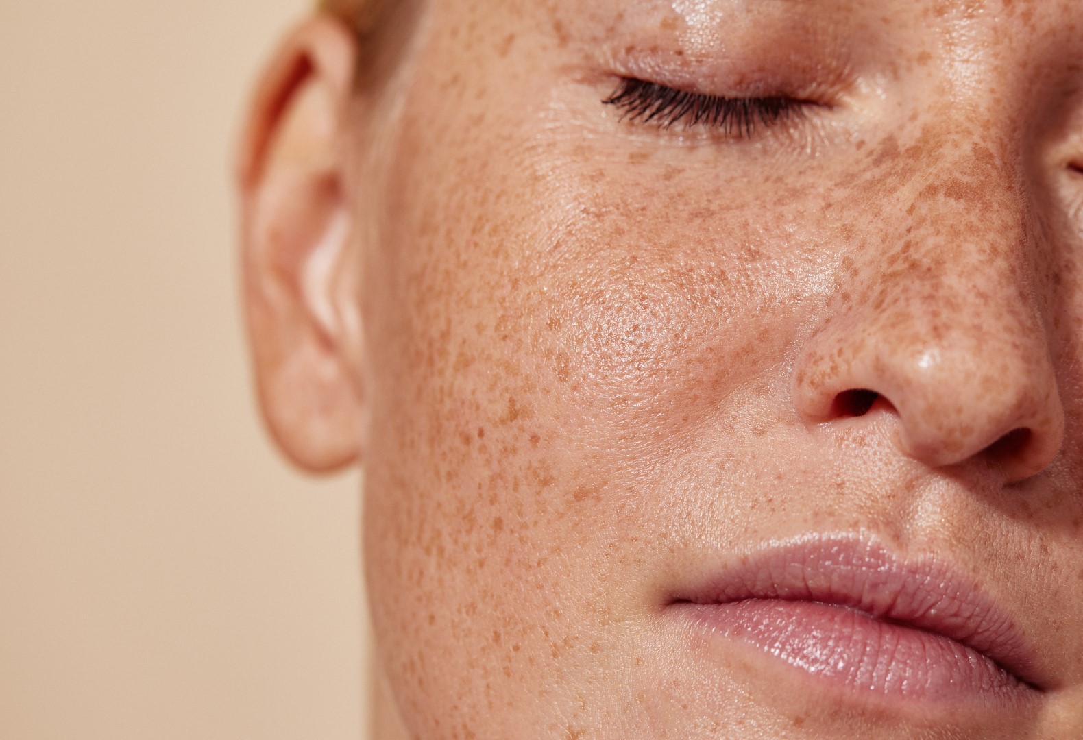 woman needing ipl therapy for sun damaged skin
