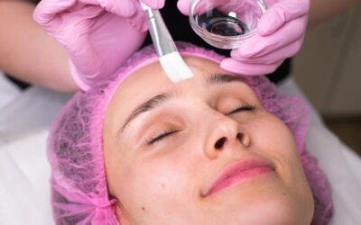 Peel Away Imperfections: The Benefits of Medical Grade Chemical Peels